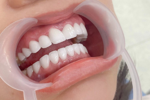 Răng sứ Titanium gắn cement – nhẹ, bền và an toàn Răng sứ Titanium gắn cement – nhẹ, bền và an toàn