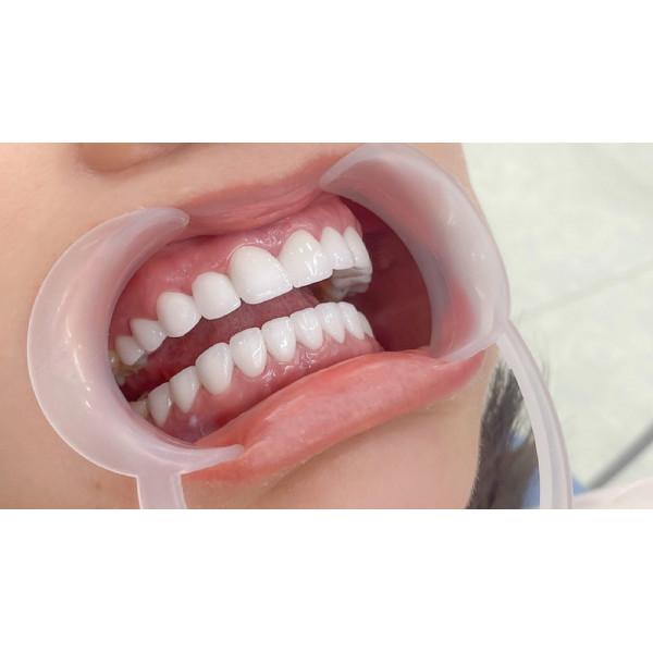 Răng sứ Titanium gắn cement – nhẹ, bền và an toàn