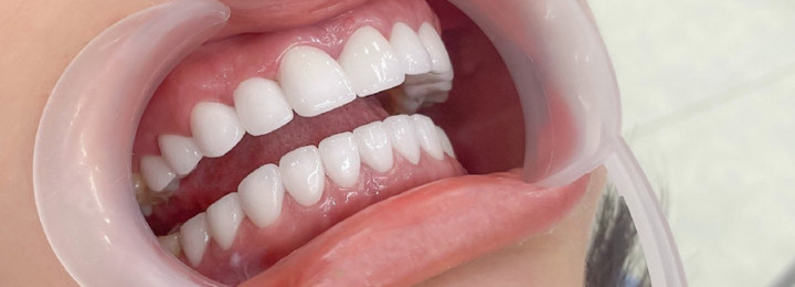 Răng sứ Titanium gắn cement – nhẹ, bền và an toàn