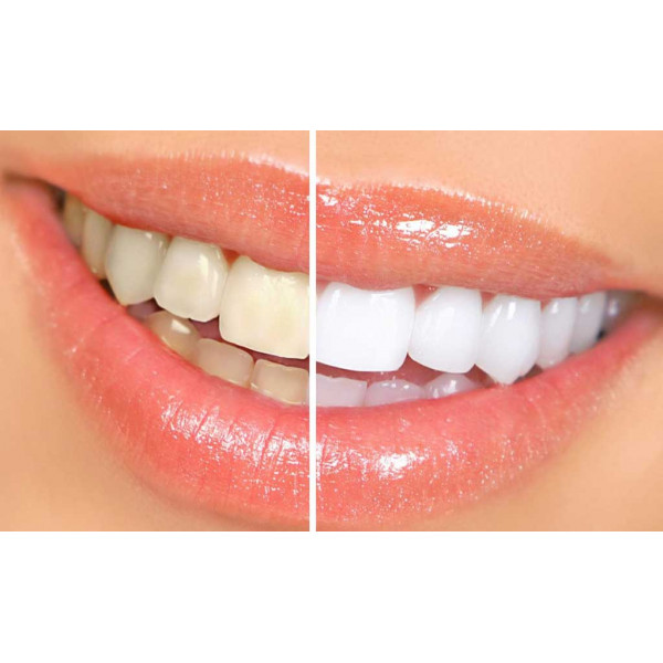 Tẩy trắng răng tại phòng khám bằng đèn Plasma hiệu quả rõ rệt