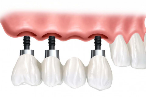 Tại sao nên chọn Implant thay vì cầu răng hoặc hàm tháo lắp? Tại sao nên chọn Implant thay vì cầu răng hoặc hàm tháo lắp?