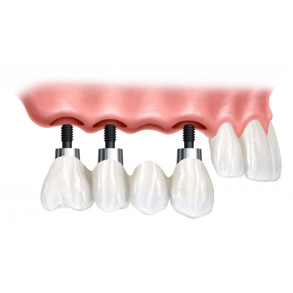 Tại sao nên chọn Implant thay vì cầu răng hoặc hàm tháo lắp?