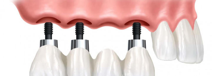 Tại sao nên chọn Implant thay vì cầu răng hoặc hàm tháo lắp?