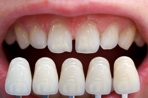 Veneer sứ toàn phần giúp bảo tồn mô răng thật tối đa