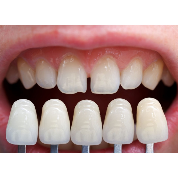 Veneer sứ toàn phần giúp bảo tồn mô răng thật tối đa