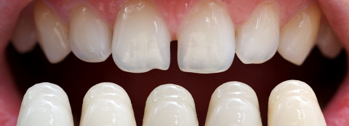 Veneer sứ toàn phần giúp bảo tồn mô răng thật tối đa