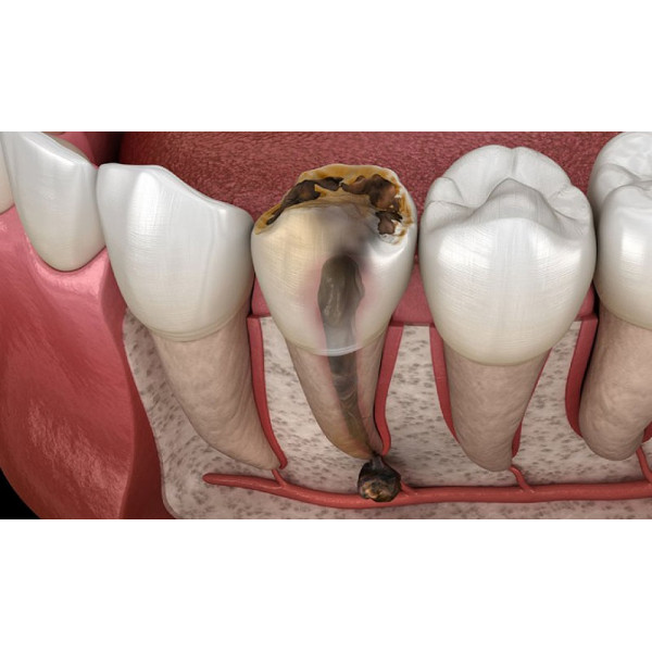 Cứu lấy răng thật trước khi quá muộn – Điều trị tủy kịp thời