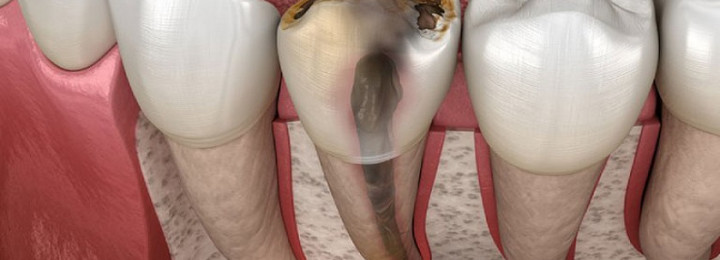 Cứu lấy răng thật trước khi quá muộn – Điều trị tủy kịp thời