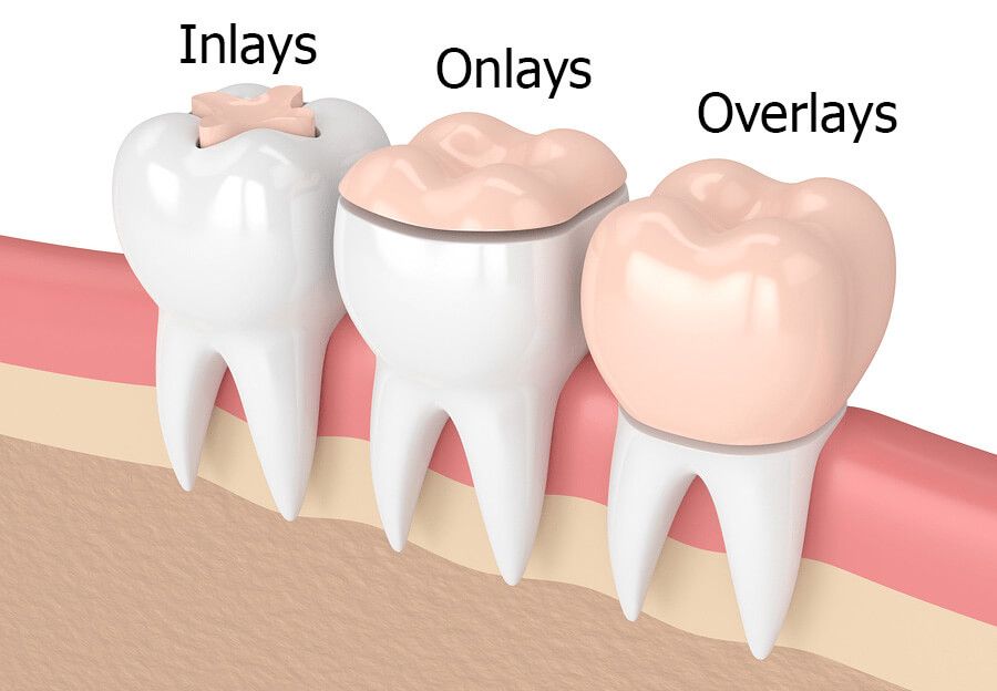 Phục hồi thânz răng bằng Inlay/Onlay