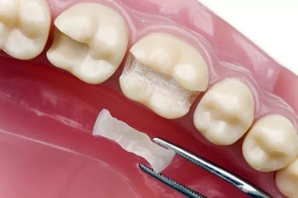 Phục hồi thânz răng bằng Inlay/Onlay