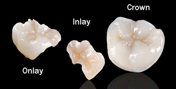 Inlay/Onlay sứ toàn phần