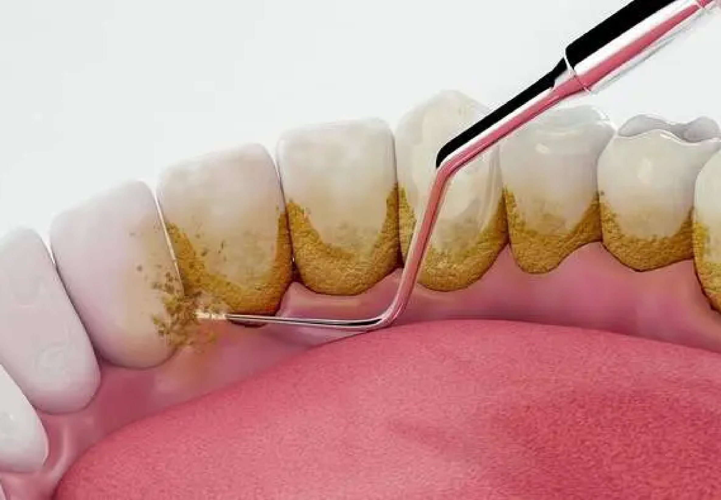 Phục hồi cổ răng bằng Composite