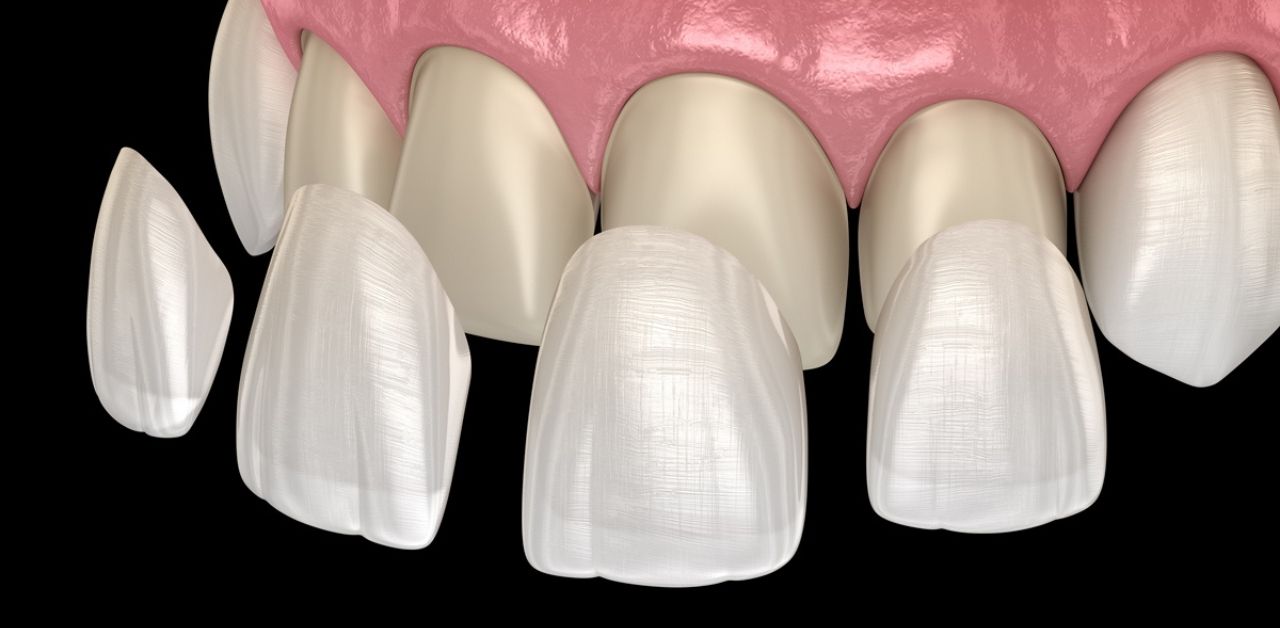 Veneer sứ toàn phần