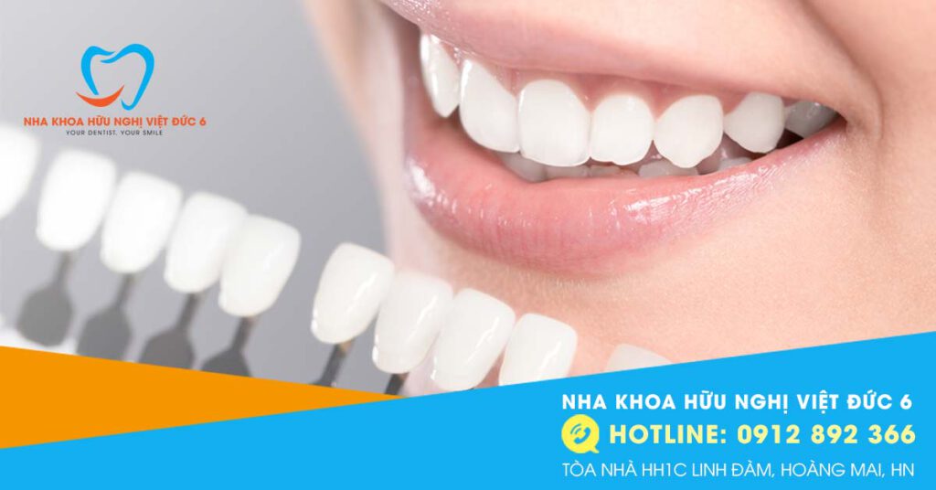 Mặt dán sứ Veneers