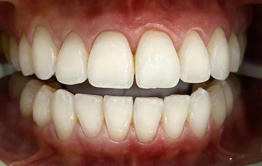 2 Whitening After 900x570 1