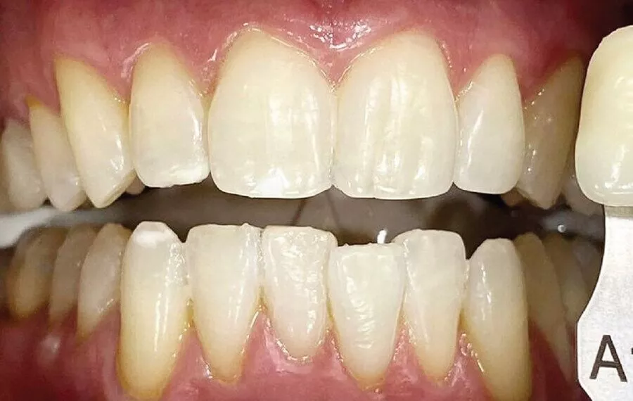 3 Whitening After 900x570 1