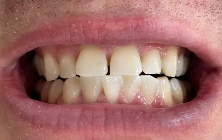 4 Whitening After 900x570 1