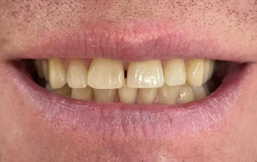 4 Whitening After 900x570 Copy