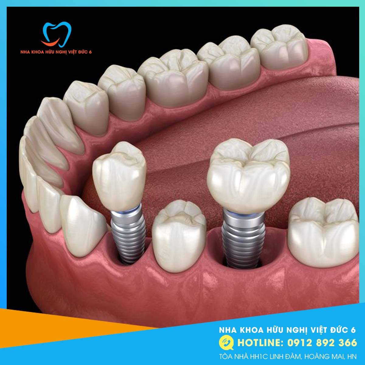 trồng răng Implant