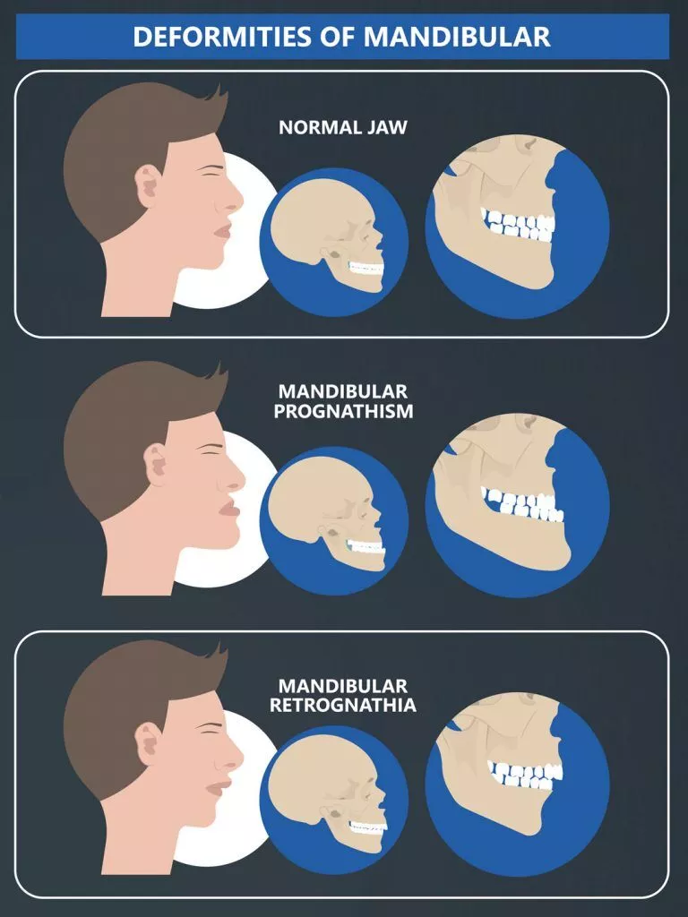 Tmj Causes 768x1024