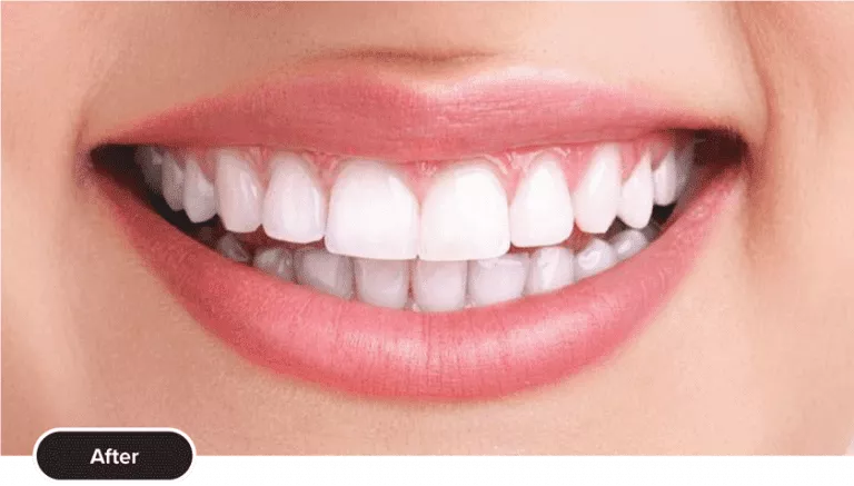 Teeth Whitening After 768x437