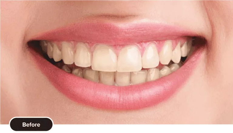 Teeth Whitening Before 768x439