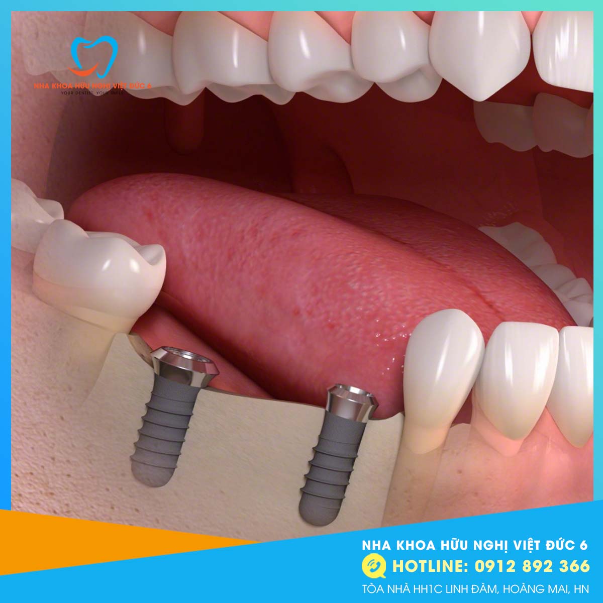 trồng răng Implant