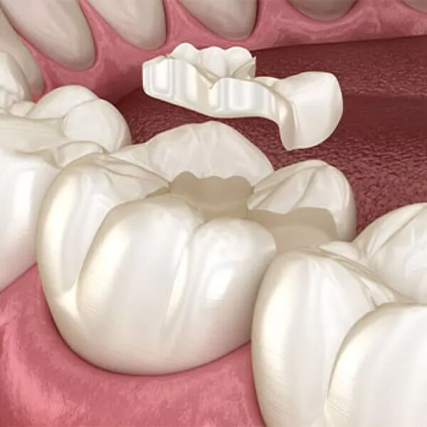 Composite Dental Filling