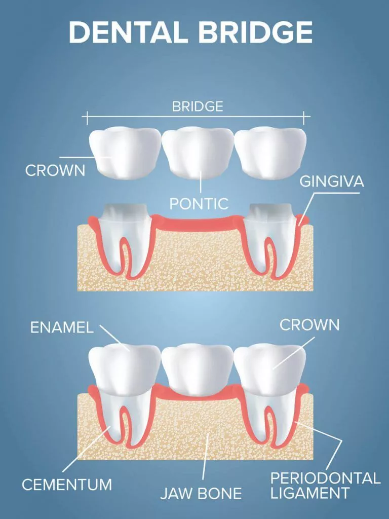 Dental Bridge Procedure 768x1024