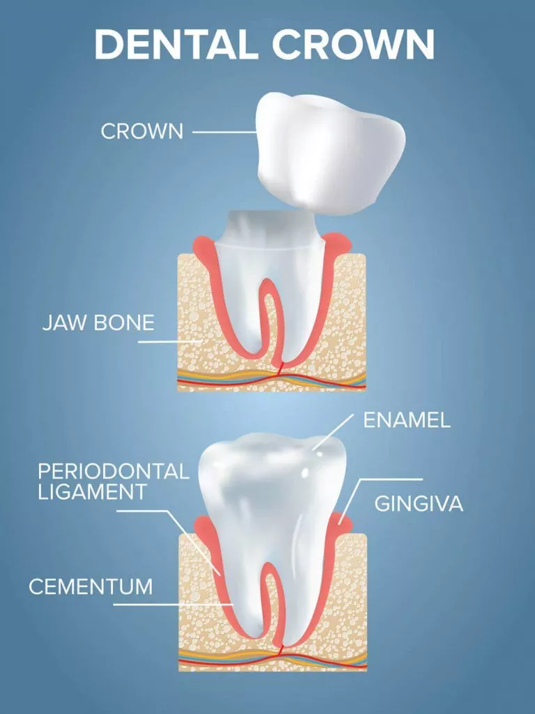 Dental Crown Procedure 768x1025