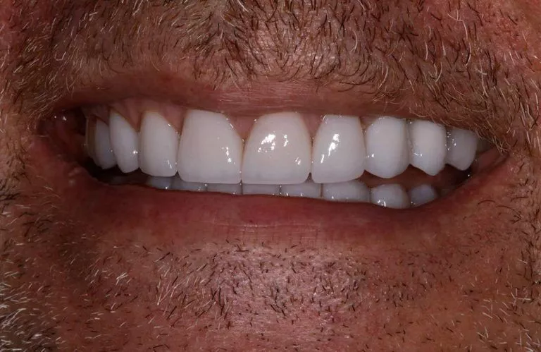 Dental Crowns 01a 768x499