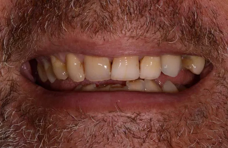 Dental Crowns 01b 768x499