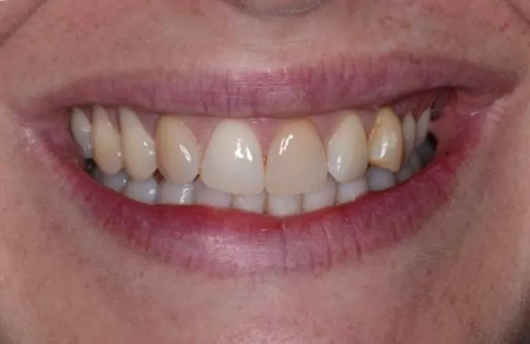 Dental Crowns 02b 768x499