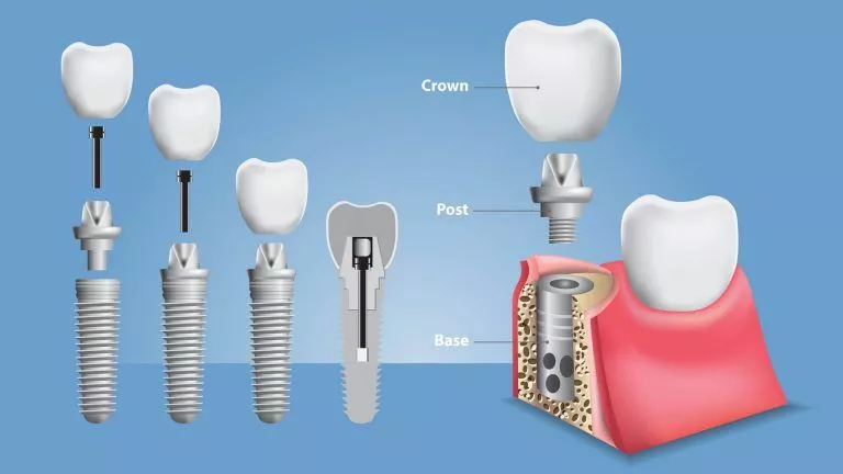 Dental Implants Dubai 768x432