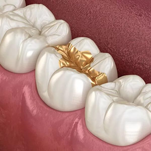 Gold Dental Filling