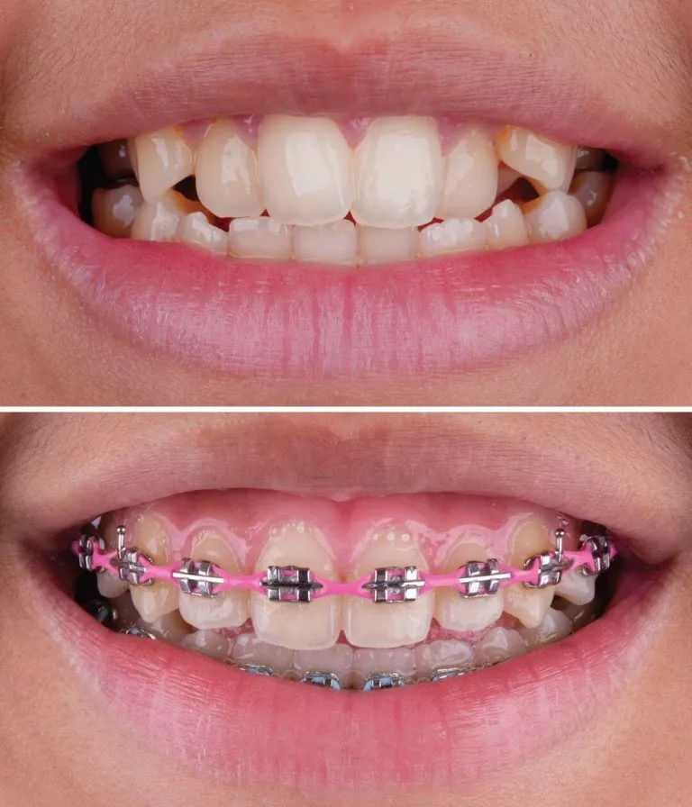 Orthodontic Treatment Dubai 768x896
