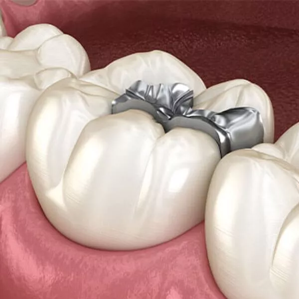 Silver Dental Filling