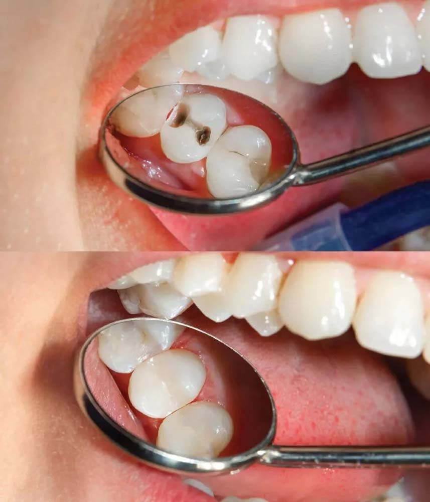 Teeth Filling In Dubai 878x1024