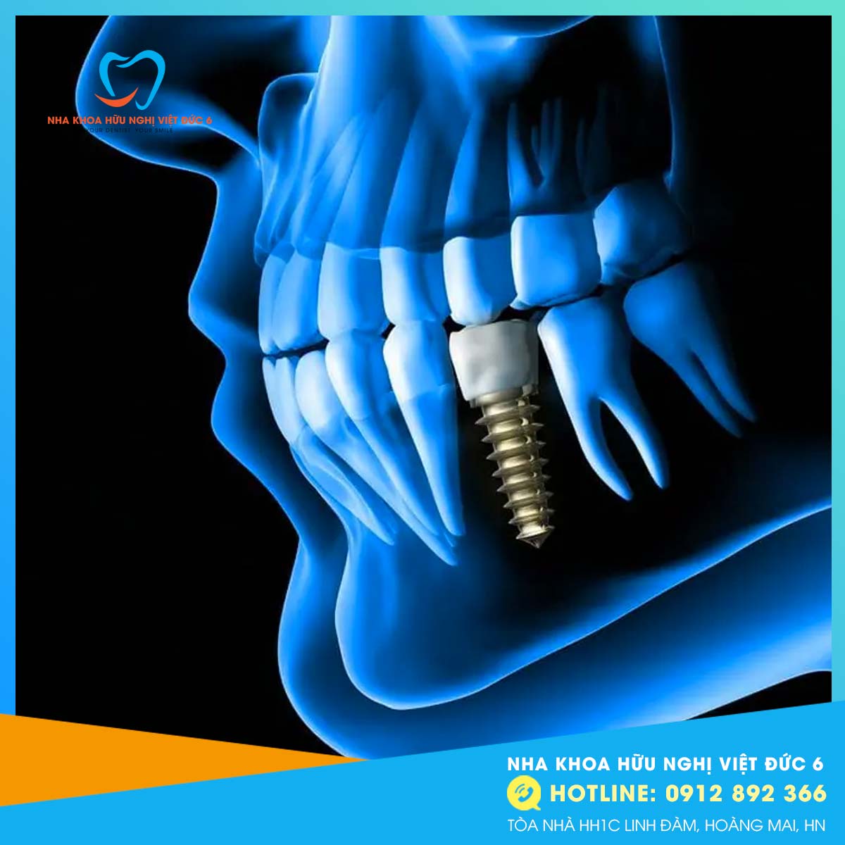 Răng Implant Bị đào Thải