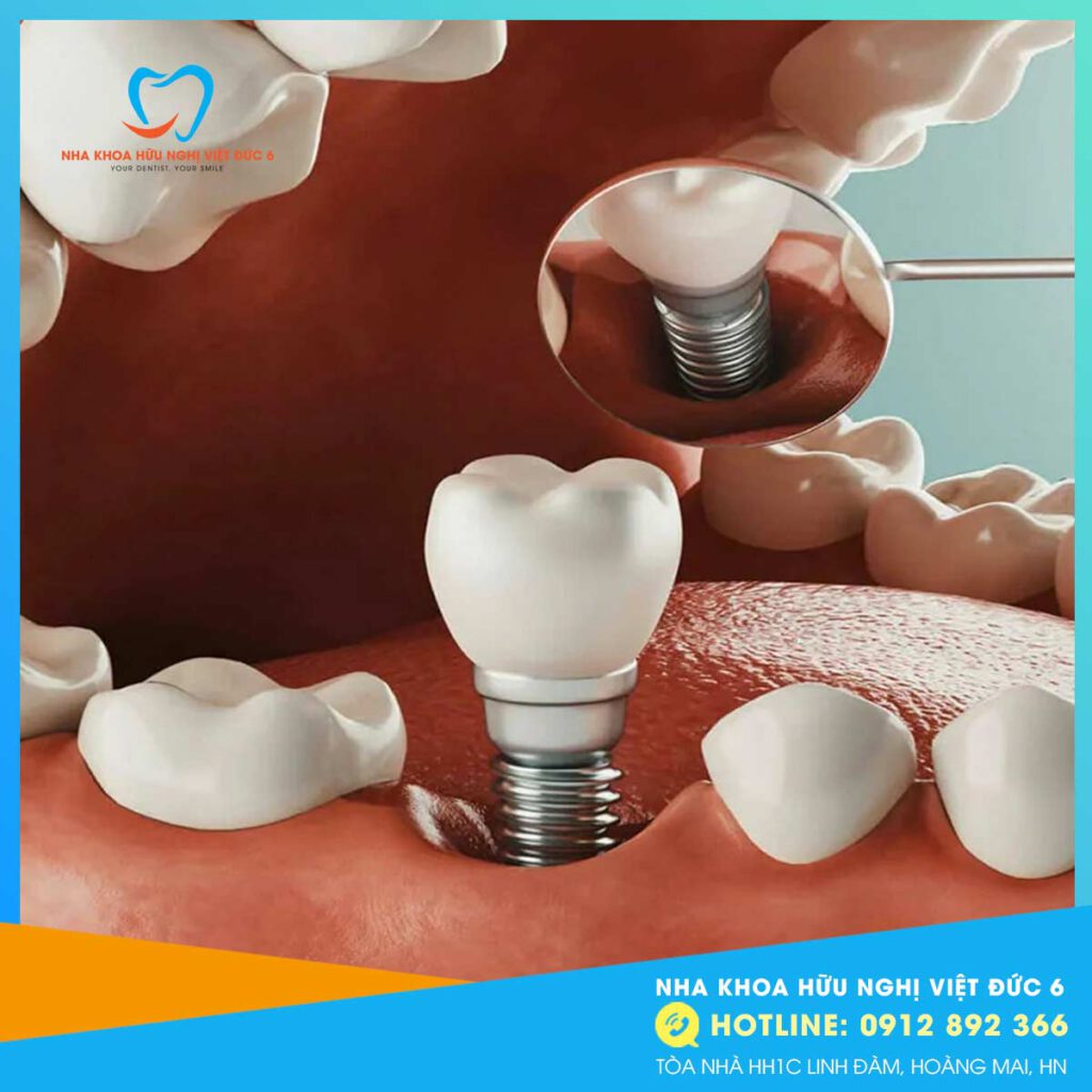 cấy trụ implant