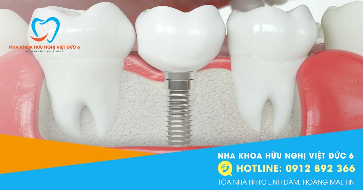 Răng Implant Bị đào Thải