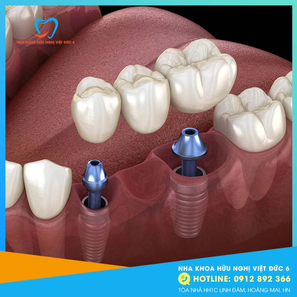 Răng Implant Bị đào Thải