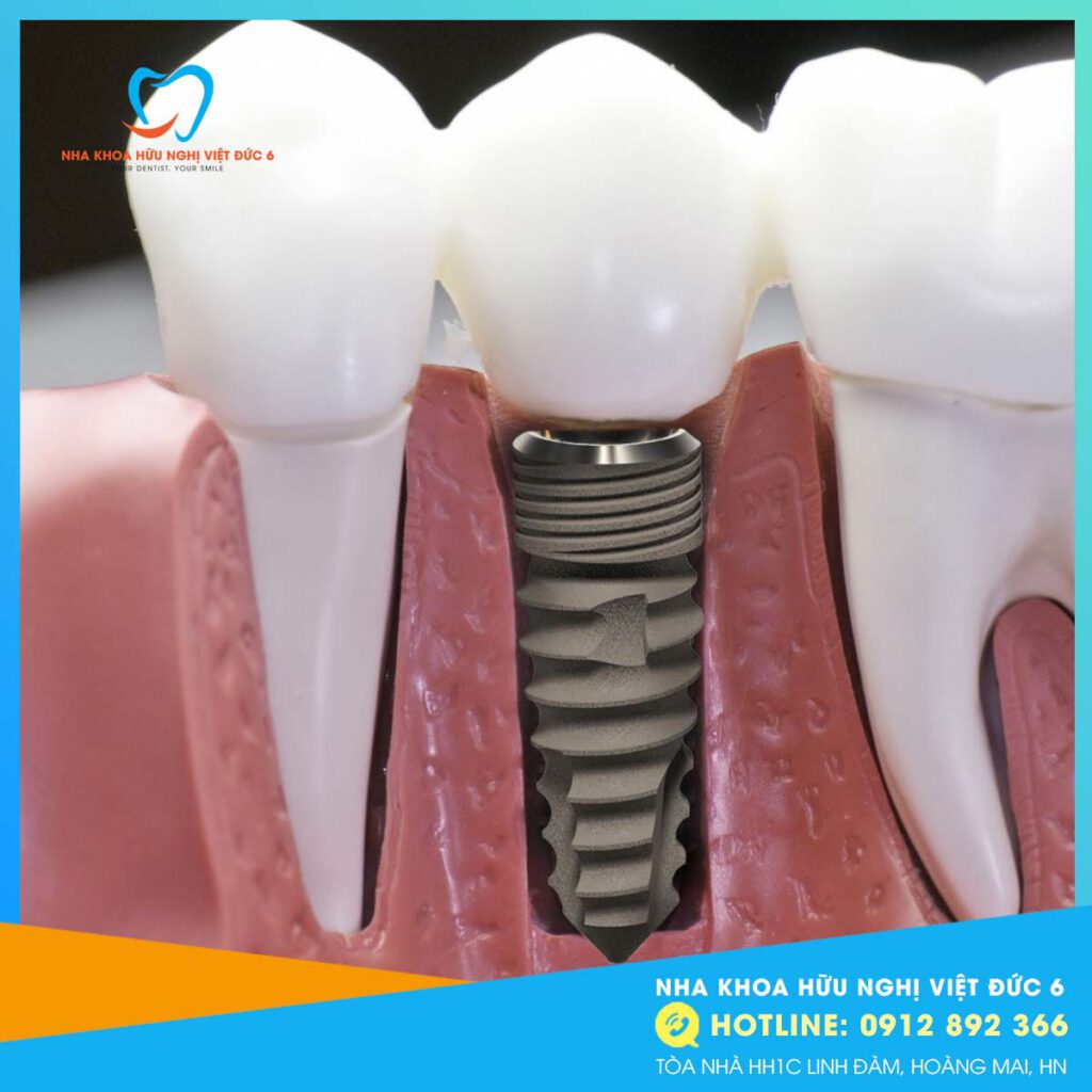 cấy ghép Implant