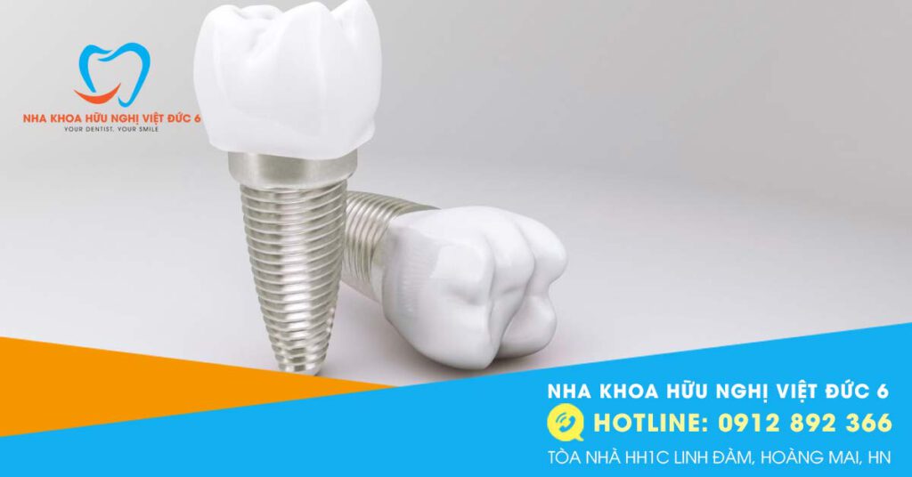 Trồng Răng Implant 21