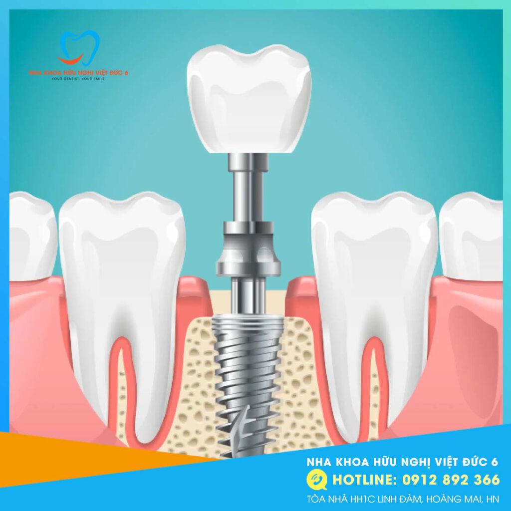 Trụ Implant bị lung lay