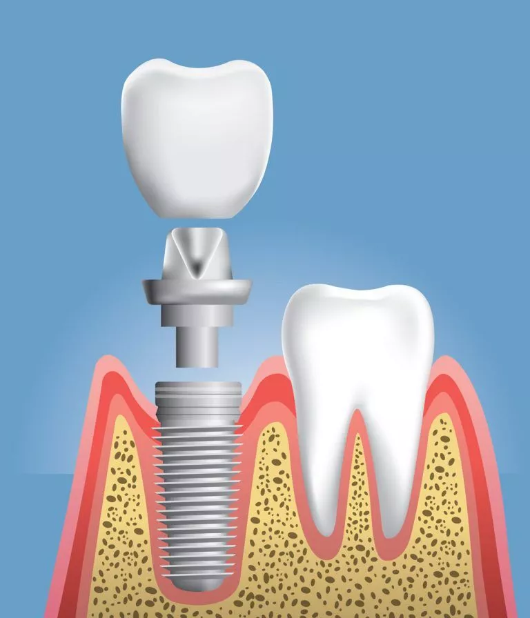 3d Guided Dental Implant Surgery 03 768x896