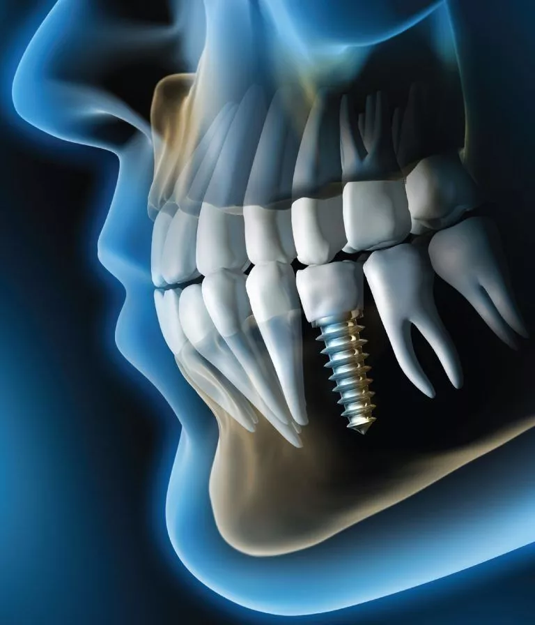 3d Guided Dental Implant Surgery In Dubai 768x896