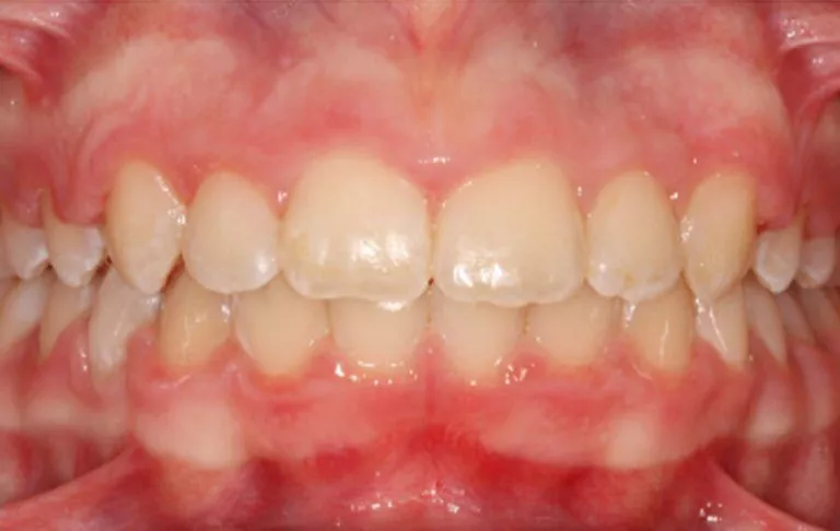 4 Braces Before 900x570 1 1 768x486