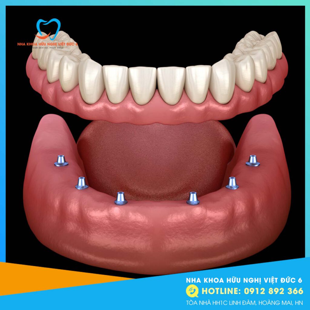 Hàm Giả Tháo Lắp Trên Implant