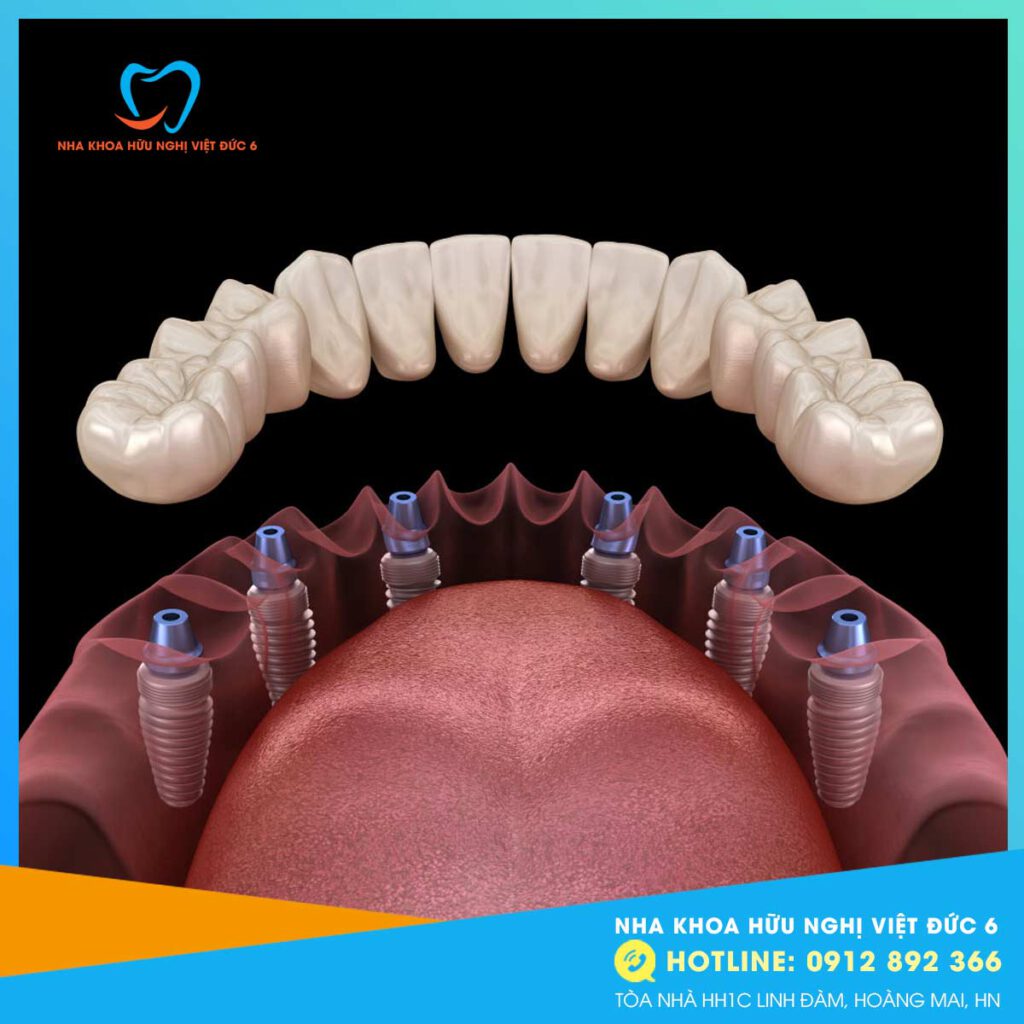 Cấy Ghép Implant All On 6.